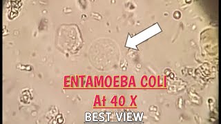 Entamoeba Coli best view in stool microscopy at 40XEColi in stool microscopyParasites in stool [upl. by Noreen]