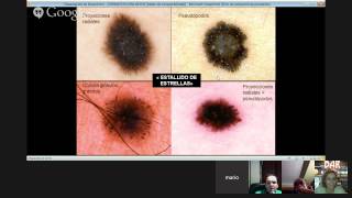 DERMATOSCOPIA DE LAS LESIONES MELANOCITICAS BENIGNASBENIGN MELANOCYTIC NEVUS DERMOSCOPY [upl. by Pippy]