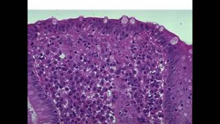 Microscopic Colitis Diagnosis and Treatment [upl. by Divadnahtanoj428]