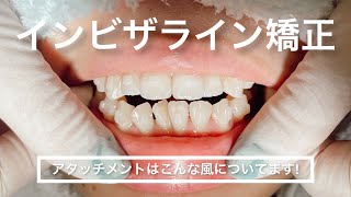 【インビザライン矯正】アタッチメントどうやってつける？徹底解説🦷 [upl. by Aileda]