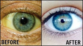 How To Whiten the Whites Of Your Eyes Naturally │ Get Rid of Dull Yellow Eyes │Sparkling White Eyes [upl. by Ahker]