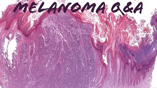 Melanoma Pathology QampA Discussion Immunostains Excision Specimens Nodal Nevus amp More [upl. by Aley]