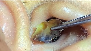 耳垢の山 MASSIVE Earwax Unearthed a pile of earwigs Big earwax earwax earwaxcleaner earwaxremoval [upl. by Aliakim]