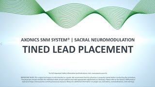 Tined Lead Procedure  Axonics SNM System® [upl. by Gebelein]