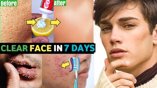 5 COMMON Skin Problems 5 Easy Solutions For HANDSOME Face  Acne Dark Skin Dark Circles [upl. by Terryl585]