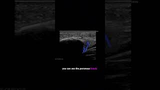 ultrasound Guided Interventions Cases Peroneus Brevis Enthesiophyte fyp sportsdoctor [upl. by Hollister]