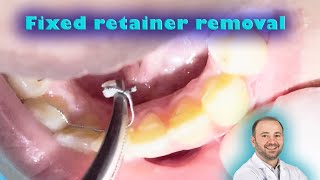 fixed retainer wire removal taking out orthodontic retainer wire steps removing permanent retainer [upl. by Stiruc430]