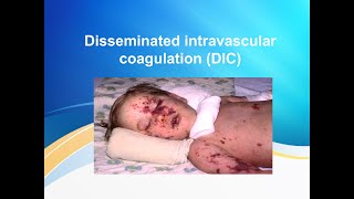 Disseminated intravascular coagulation DIC [upl. by Leummas]