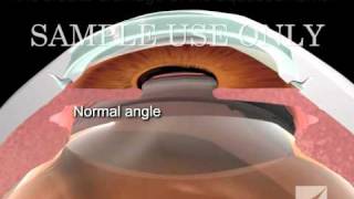 Diagnosis and Treatment of Closed Angle Glaucoma [upl. by Notsej]