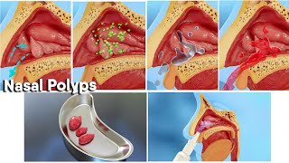 Nasal polyps treatment and surgery 3d medical animationDandelion Team nasalpolyp noose [upl. by Damicke783]