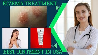 eczema treatment eczema causes and Ointment [upl. by Eslek]