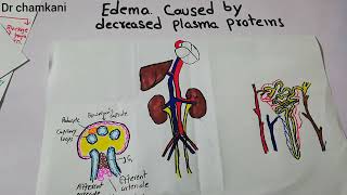 Renal physiology 27  Causes of edema caused by decreased plasma proteins DrChamkani [upl. by Anesusa]