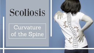 Scoliosis  abnormal curvature of the spine [upl. by Derek]