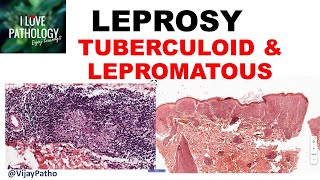 LEPROSY etiopathogenesis classification Tuberculoid amp lepromatous leprosy [upl. by Attennaej]