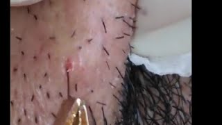 Ingrown Hairs Extraction  Infected Ingrown Hair Cyst Treatment [upl. by Kinnard742]