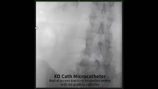 XO Cath Used in a Uterine Artery Embolization without the use of a support catheter [upl. by Noinatrad961]