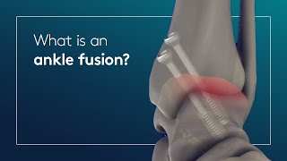 What is an ankle fusion [upl. by Nsaj]