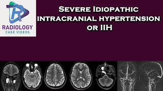 Severe Idiopathic intracranial hypertension or IIH [upl. by Ispep]