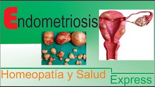 Endometriosis Tratamiento homeopatico [upl. by Harbert]