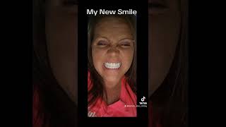 Before and After Dentures denturegang dentures newsmile dentist [upl. by Scevor]