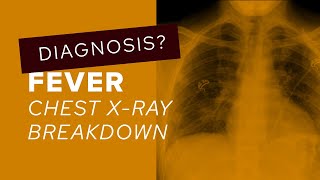 Chest XRay breakdown assessing lung nodules in young patients [upl. by Guglielma]