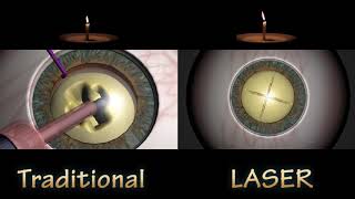 FLACS VS TRADITIONAL CATARACT SURGERY  Nucleus Removal Compare [upl. by Adnaluoy]