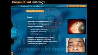 conjunctival neoplasms [upl. by Mihe]