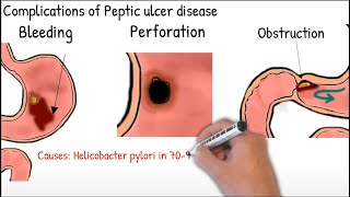 Gastric ulcer and duodenal ulcer in 2 minutes Peptic ulcer disease [upl. by Browning527]