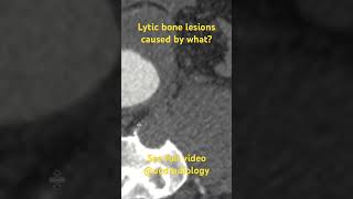 Lytic bone lesions caused by what doctor medicalstudent radiologyresident radiology radres [upl. by Hadwin]