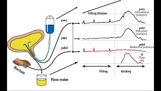 URODYNAMIC STUDY IN CHILDRENBASICS TO ADVANCED [upl. by Mauralia259]