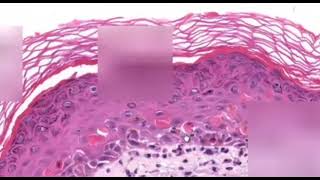 Erythema Multiforme Dermatopathology Easy learning [upl. by Cul512]