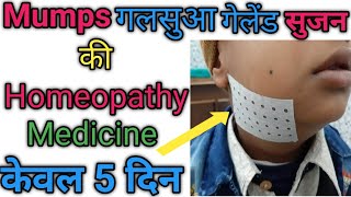 Mumps  गलसुआ  homeopathc medicin for mumps diseases [upl. by Hild]