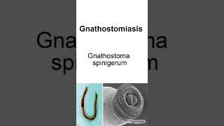 How to Pronounce Gnathostomiasis Gnathostoma spinigerum [upl. by Otirecul]