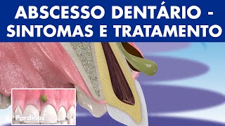 Abscesso dentário  Sintomas de abcesso no dente e tratamento © [upl. by Nsaj]