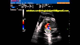 Ecocardiograma fetal Cardiopatía Congénita APSI [upl. by Enylhsa]