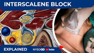 UltrasoundGuided Continuous Interscalene Brachial Plexus Block  Regional Anesthesia [upl. by Sheline449]