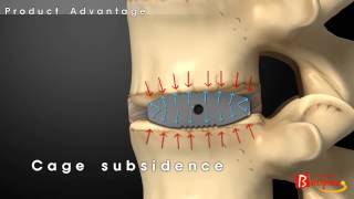 Bioflex Functional Cage SystemBiospine [upl. by Peace]