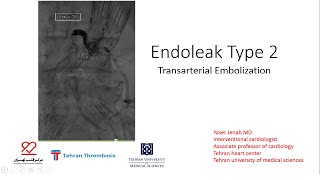 Endoleak Type 2 Transarterial Embolization [upl. by Macfadyn955]