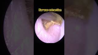 Check out this ear wax removal 😊Super satisfying [upl. by Rabassa]