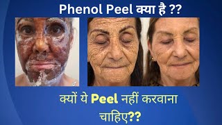 जानिये Phenol Peel के बारे में  what is Phenol Peel [upl. by Yolanda635]