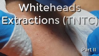 Whiteheads Extraction TNTC  Session I  Part 2 of 3 [upl. by Zashin961]