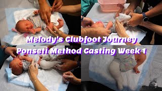 Cast 1 Melodys Clubfoot Treatment Journey Ponseti Method Casting new experiences and tricks [upl. by Legnaros]