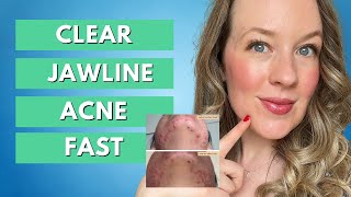 Jawline Acne  CLEAR CYSTIC ACNE ON JAWLINE FAST [upl. by Aerdnua]