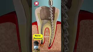 Importants of root canal treatment  steps of rct dentist rootcanaltreatment [upl. by Trotta]