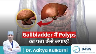 Gallbladder में Polyps का पता कैसे लगाएं  Dr Aditya Kulkari [upl. by Michaella]