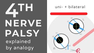 Fourth Nerve Palsies  Animation  Explained Conceptually [upl. by Lednor]