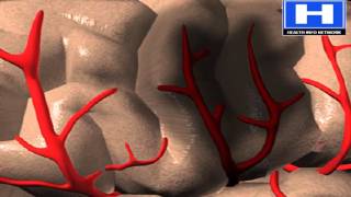 Embolism vs Thrombus symptoms causes pathophysiology and treatment [upl. by Francis]