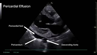 PoCUS Echo  Pericardial vs Pleural Effusions [upl. by Banna]