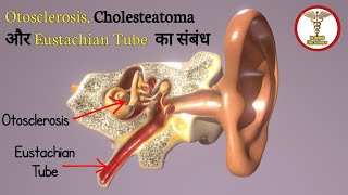 nasal decongestant spray  eustachian tube dysfunction [upl. by Charmian]