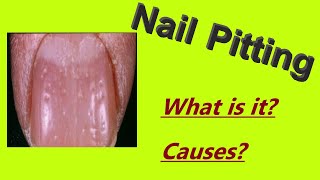 Nail pitting Pitted nails [upl. by Jacoba]